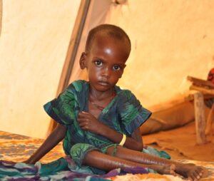 Color photo of undernourished African child.